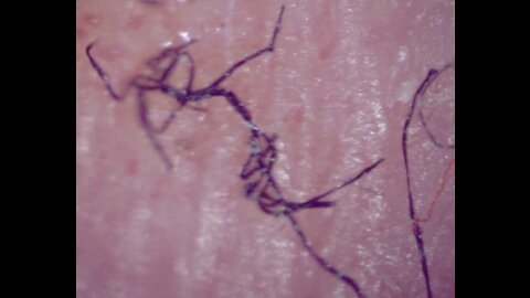 Synthetic Parasite Morgellons Found in Covid-19 Swabs 💥