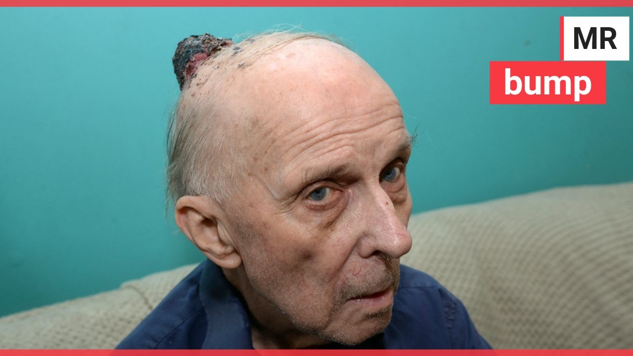 Pensioner develops lump on head size of orange