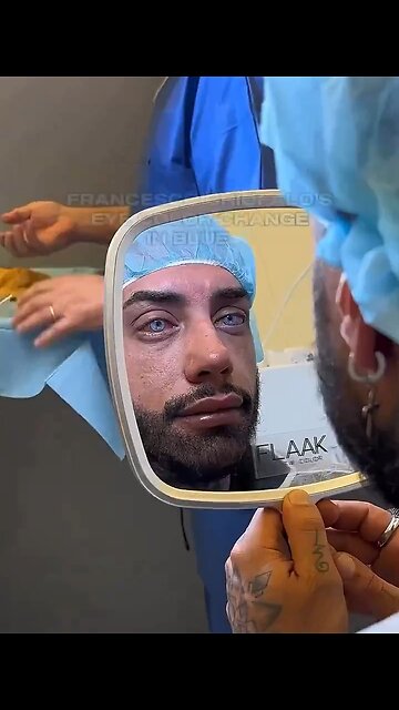 this guy got eye surgery to change his eyes to blue