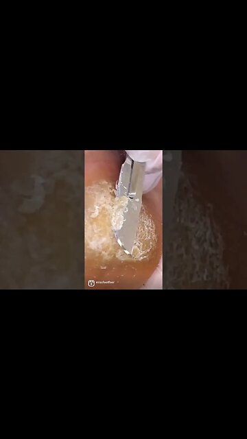 #heels #calluses #callusremoval #callus #missfootfixer #nails #cornsonfeet #harleystreet