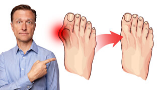 How to Fix Bunions in 3 Steps