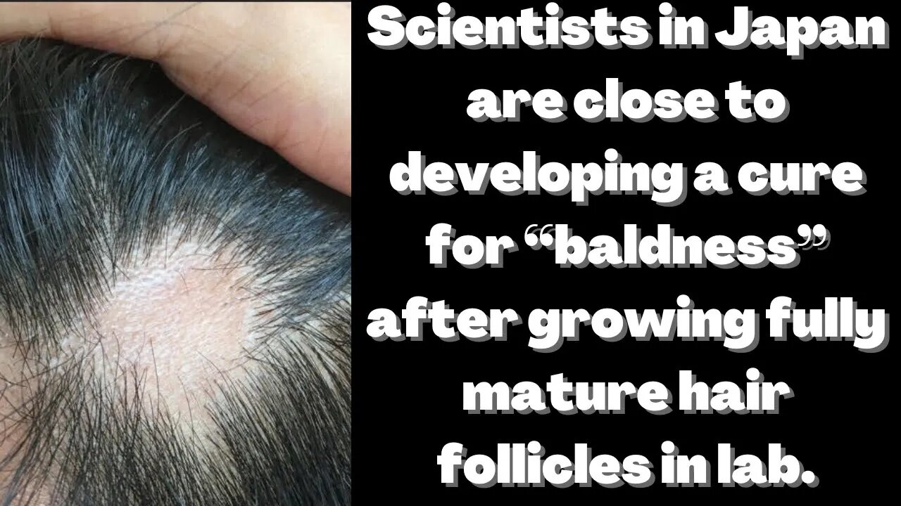 |NEWS| The Cure For Male Pattern Baldness Is In Sight