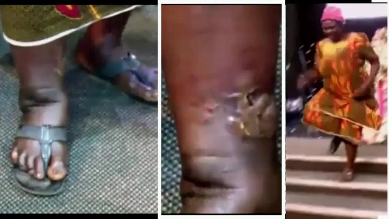 Leg Stepped On African Cham Healed [TESTIMONY]