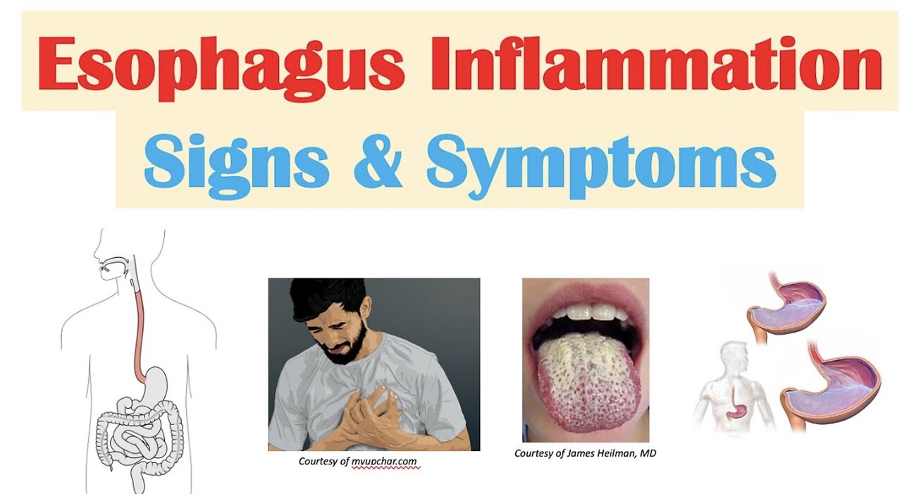 Esophagitis (Esophagus Inflammation) Signs & Symptoms (& Why They Occur)