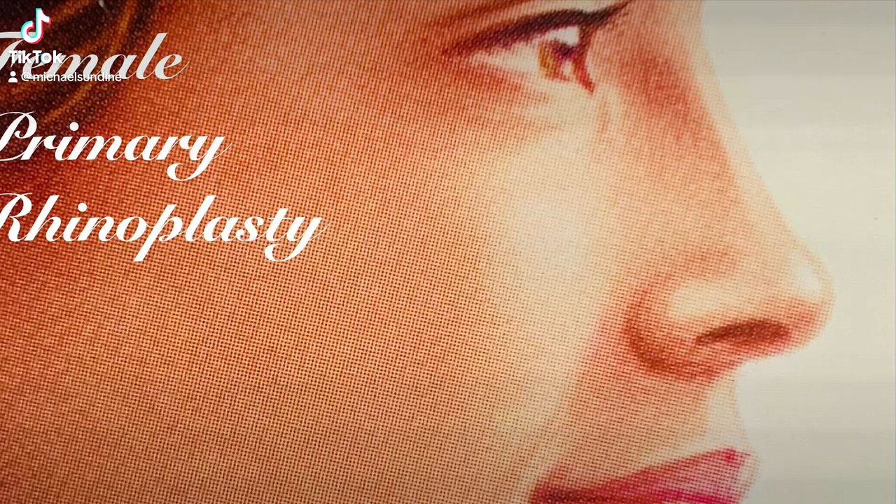 Female primary rhinoplasty