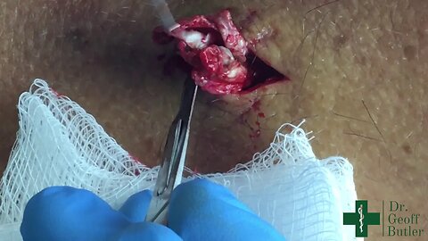 Removal of an Epidermal cyst where the capsule ruptures