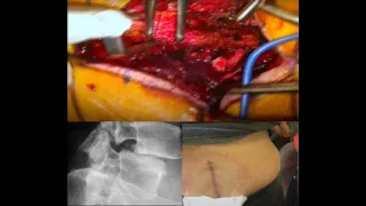 Spondylolisthesis Patient Walks 2 Weeks After Spine Surgery