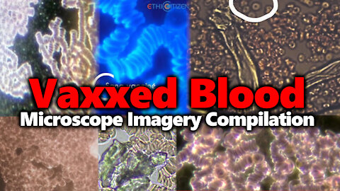 Vaxxed Blood Under Microscope: Compilation Of Research From Numerous Separate Investigations