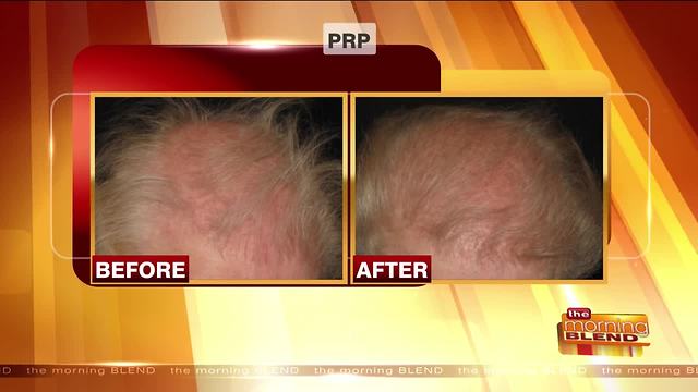 An Impressive Option for Hair Restoration