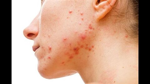 How to Treat Adult Acne & Heavy Periods