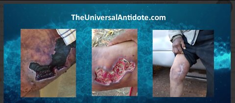 Leg Wound Healed with Chlorine Dioxide