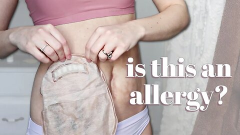 Allergy to Ostomy Bags? | Let's Talk IBD