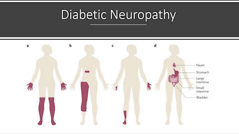 Diabetic Neuropathy - Natural Treatment