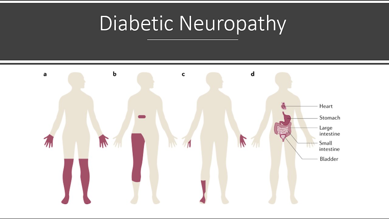 Diabetic Neuropathy - Natural Treatment