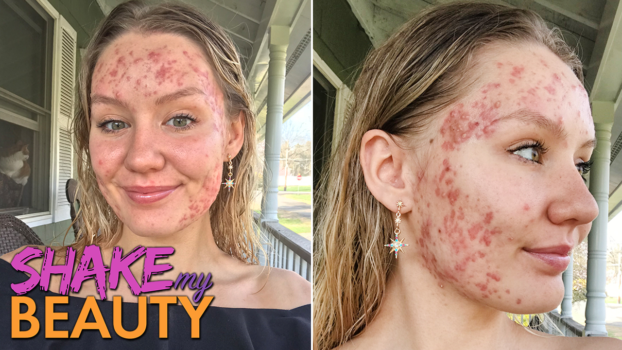 My Acne Became A 'Monster' At 20 | SHAKE MY BEAUTY