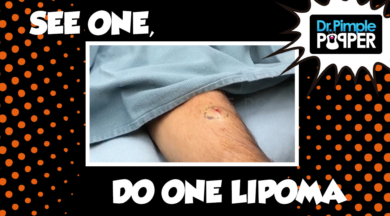 See One, Do One, Lipoma