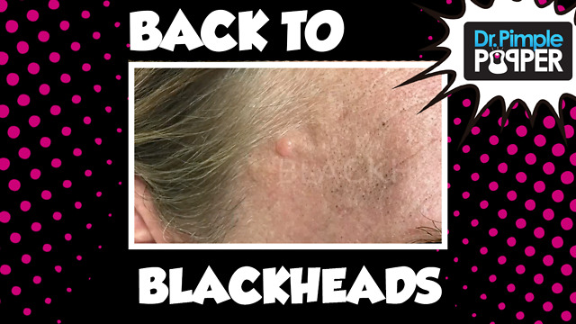 Back to Blackheads!