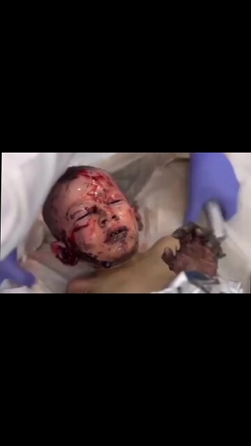 These Little Children Were Severely Burned From US Funded Israeli Bombs [HYM]