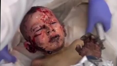 These Little Children Were Severely Burned From US Funded Israeli Bombs [HYM]