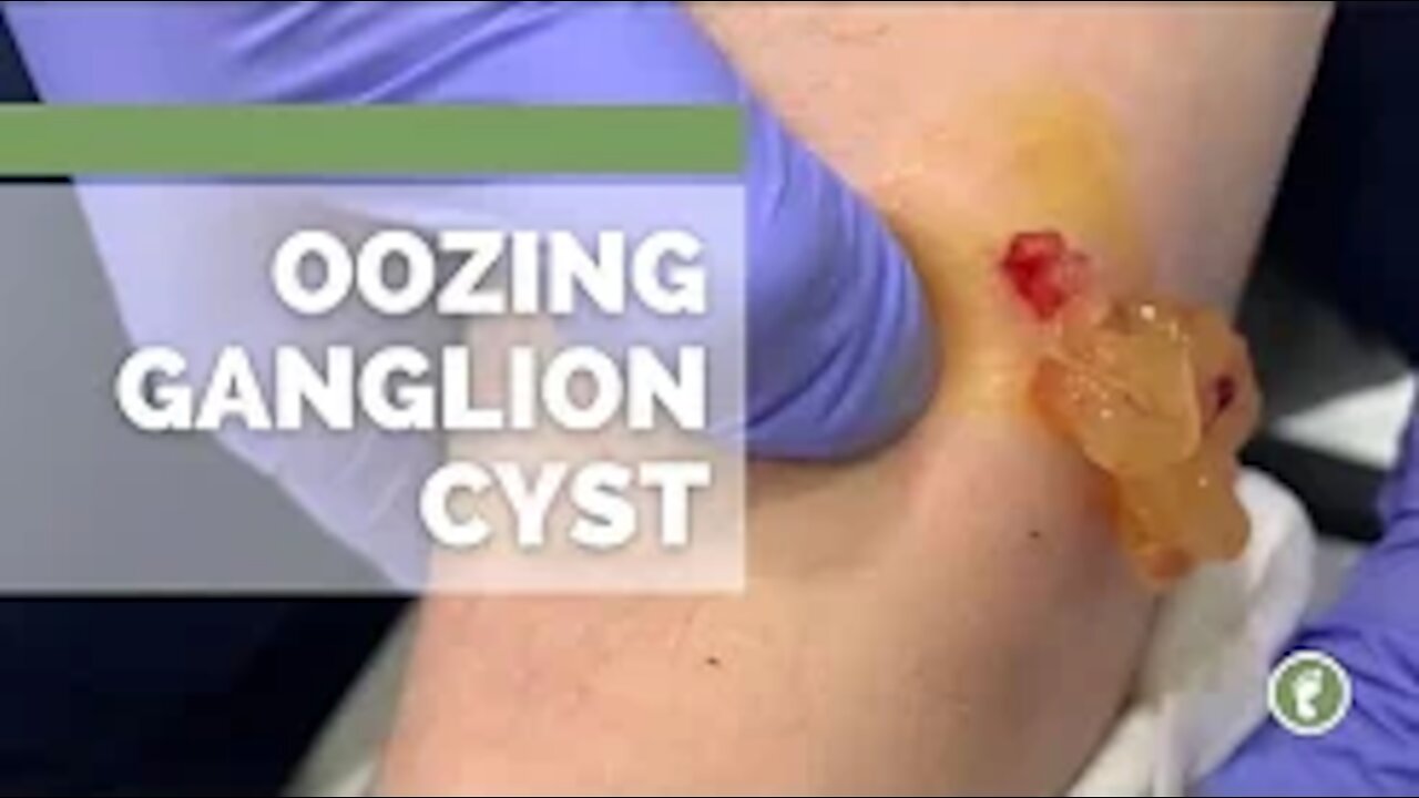 OOZING GANGLION CYST!!!!