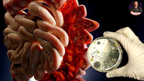 Diverticulosis is Prevented By Fiber? Time to Rethink the Common Knowledge on Gut Disease!