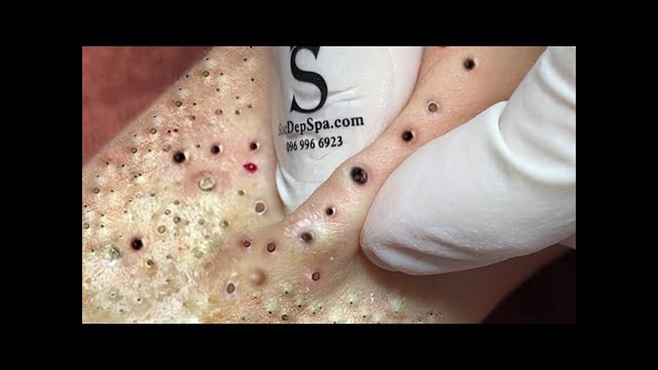 Satisfying blackhead removal, relaxing Pimple Popper 612