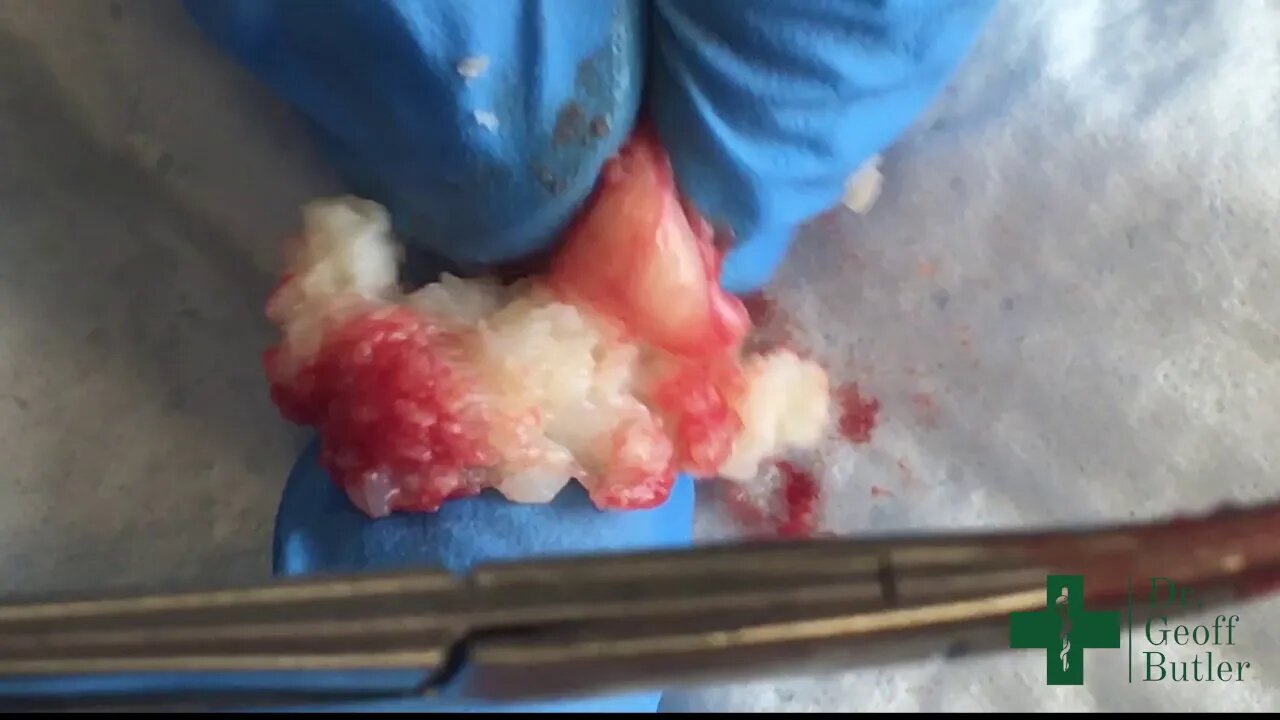 Removal of an Epidermal Cyst on the back with minimal rupture