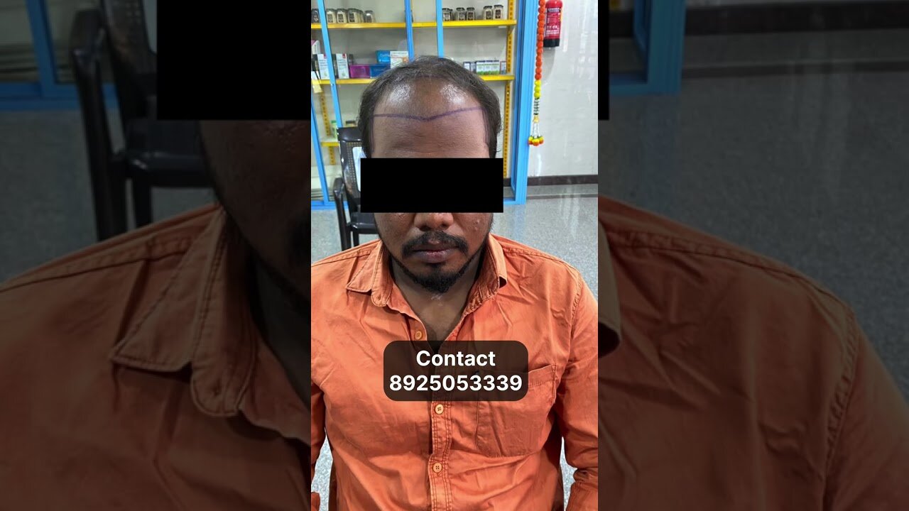 9 Months Hair Transplant Result