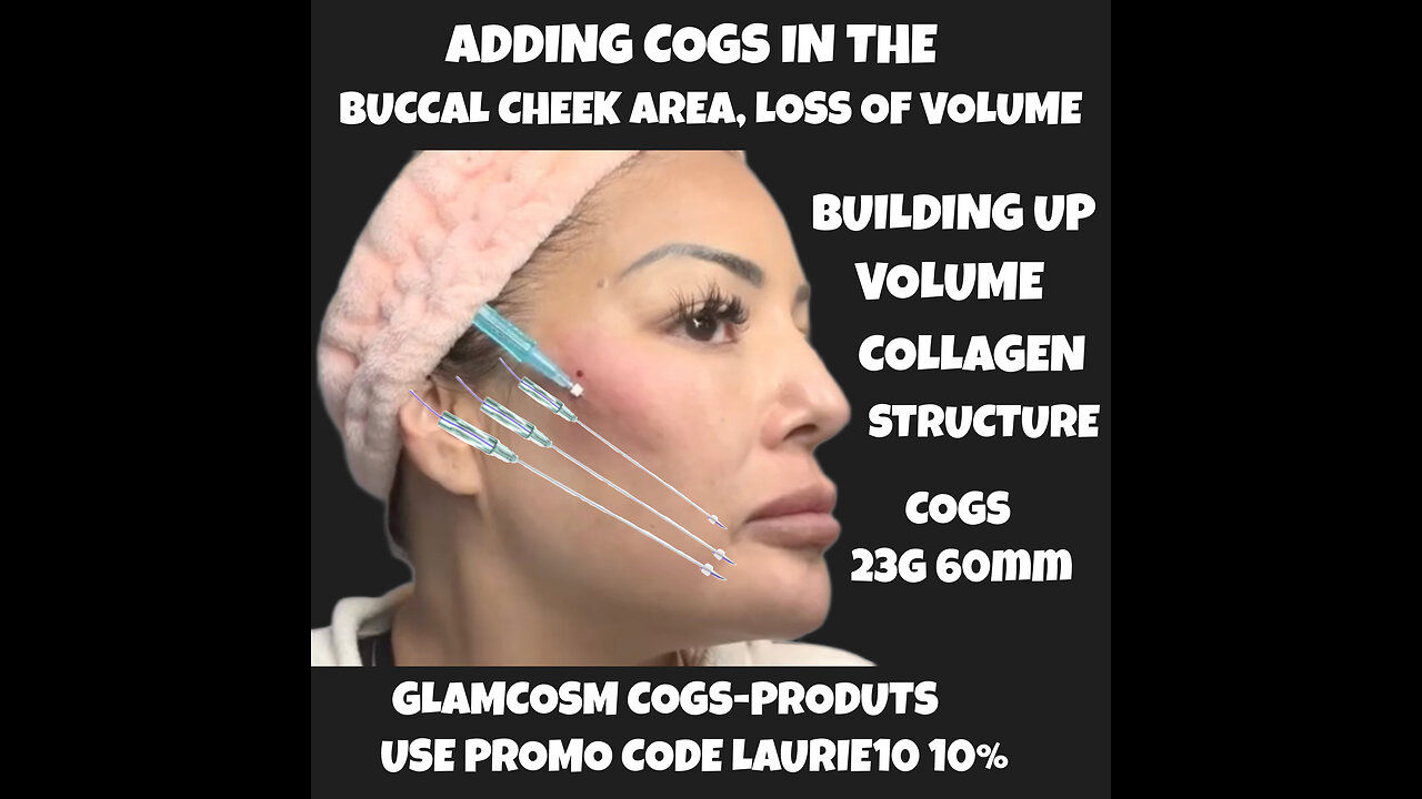 WoW Adding Two Cogs In My Cheek/Buccal Cheek Lifted My Nasolabial Folds