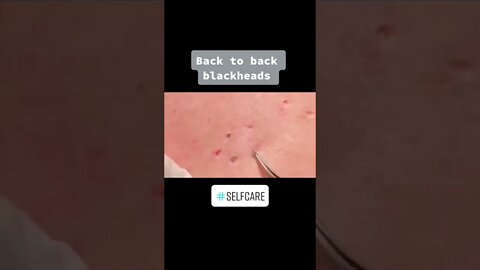 Blackheads Removal on the Back PART 4