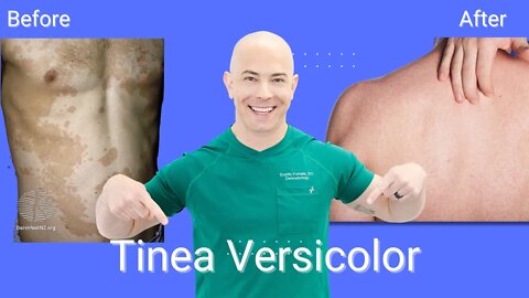 How to Treat Tinea Versicolor and Keep it From Coming Back￼