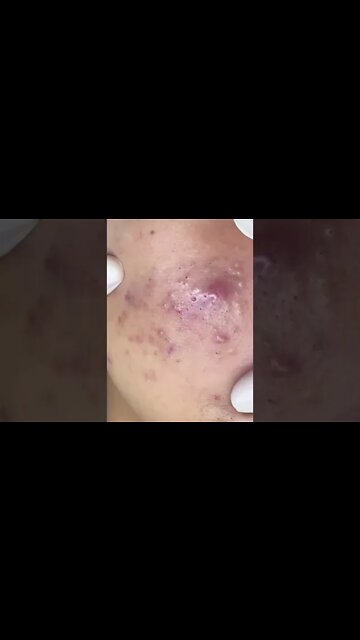 Pimple Popping Extraction #fyp #shorts