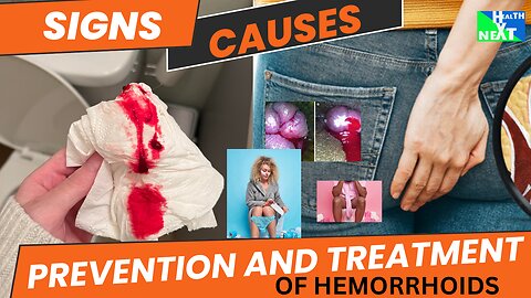 SIGNS,CAUSES,HOW TO PREVENT AND TREAT HEMORRHOIDS OR PILES