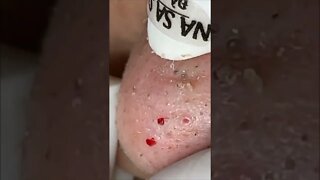 Huge Pimple Pop Blackheads Removal