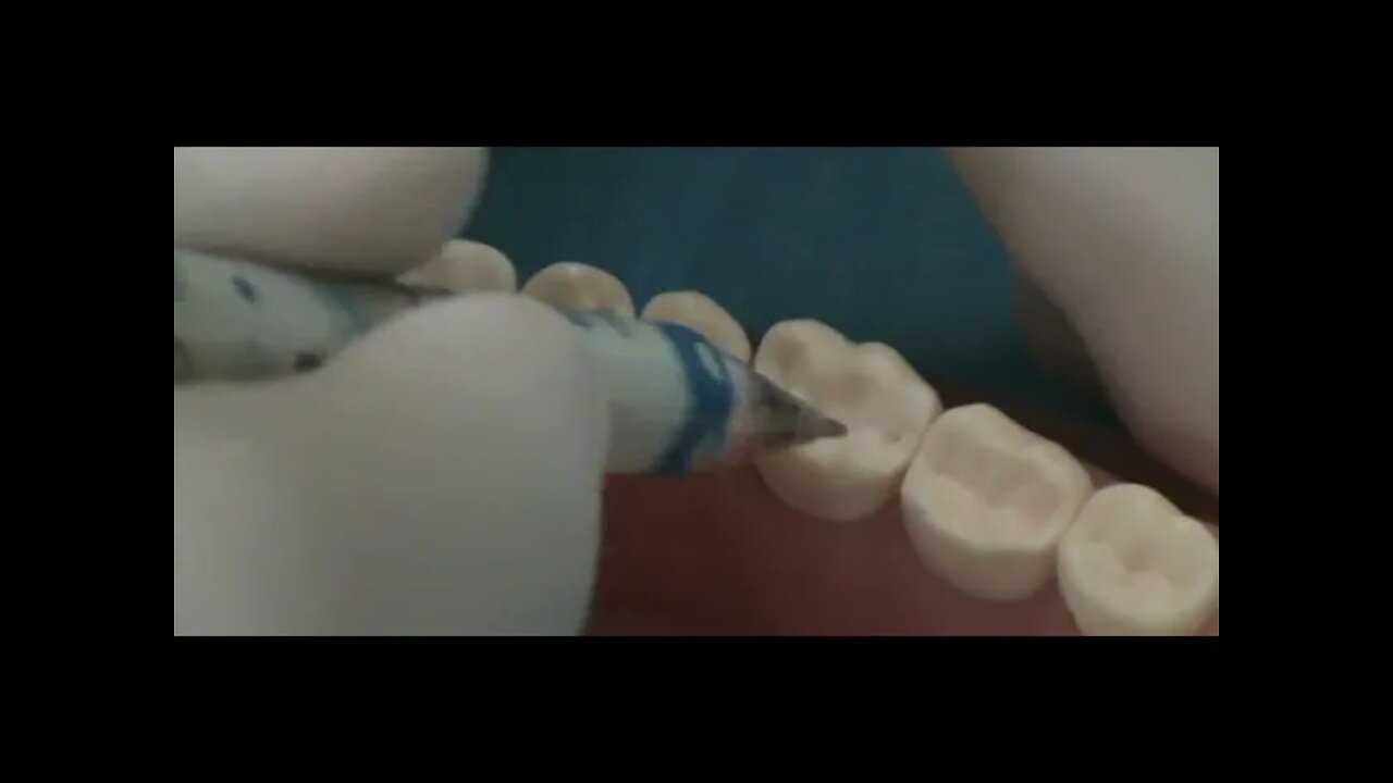 Class I Occlusal Surface Lower Right First Molar