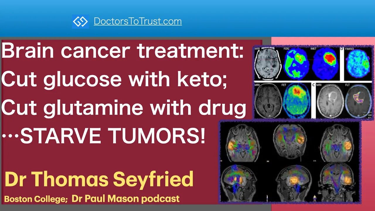 TOM SEYFRIED 6 | Brain cancer treatment: Cut glucose with keto; & glutamine with drug…STARVE TUMORS!