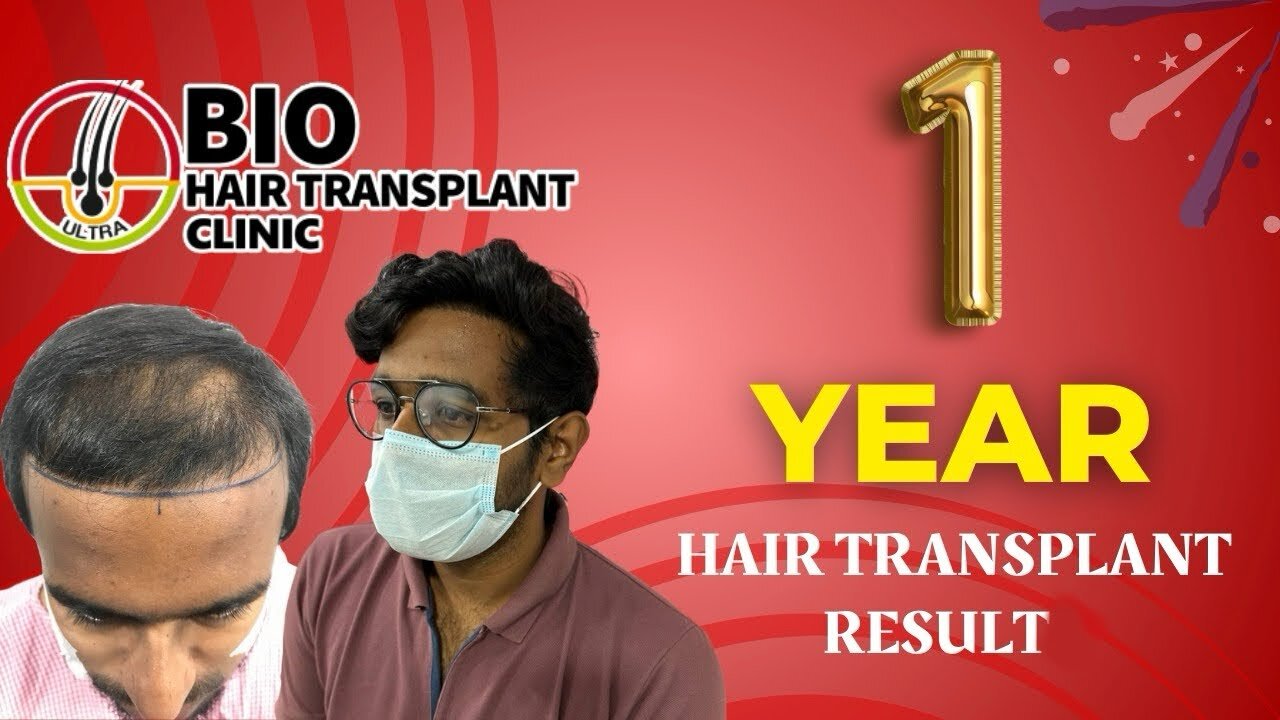 1 Year Hair Transplant Result