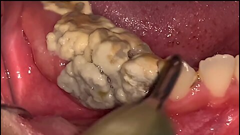 Scaling teeth tartar