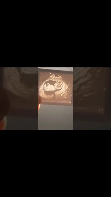 Ultrasound Lithophane