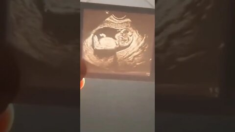 Ultrasound Lithophane