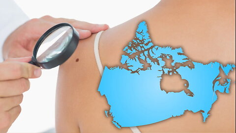 Skin cancers may be going undiagnosed in Canada due to few dermatologists