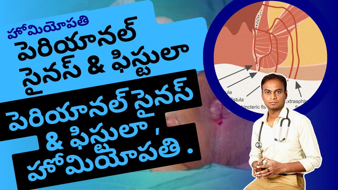 పెరియానల్ సైనస్, ఫిస్టులా మరియు హోమియోపతి చికిత్స . | Dr. Bharadwaz |Medicine & Surgery