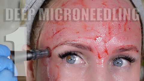 Deep Microneedling with PDRN & Stem Cells | Gorgeously Aging