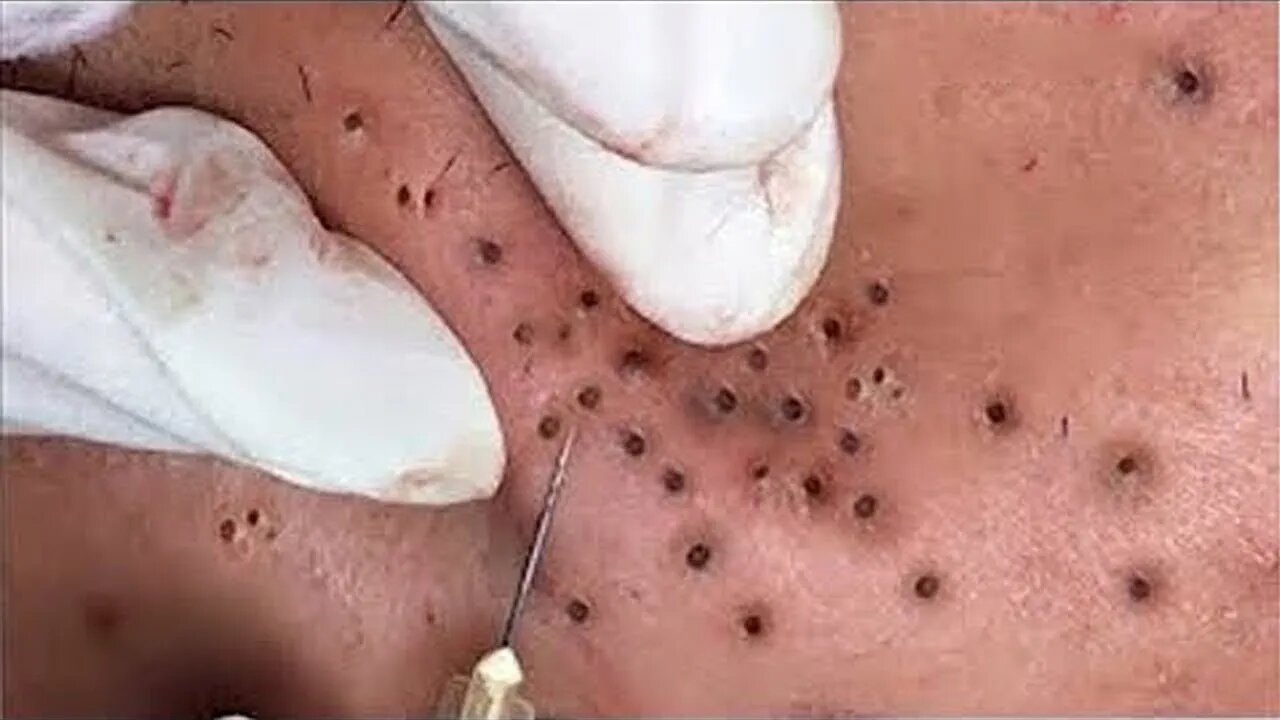 Removendo CRAVOS Pretos Profundos,Vídeo Satisfatório Espremendo Cravos e Espinhas 2022 Blackhead