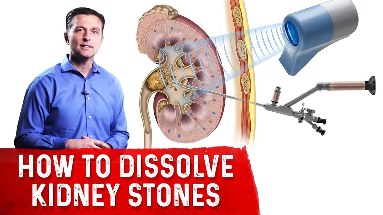 How To Dissolve Kidney Stones Explained By Dr.Berg