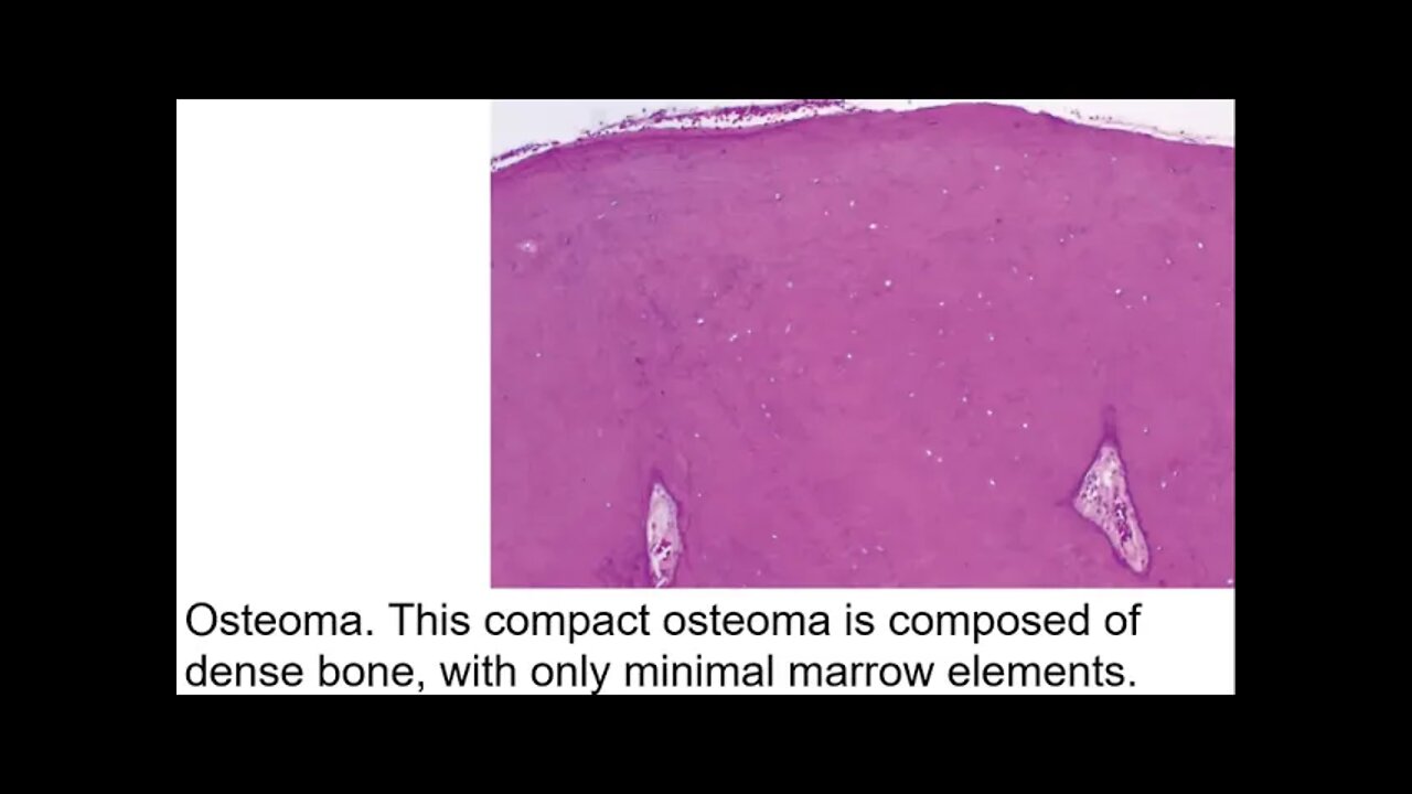 Oral pathology L15 part2 (Paget’s disease, Tumors, and Tumor-like lesions of Bone)