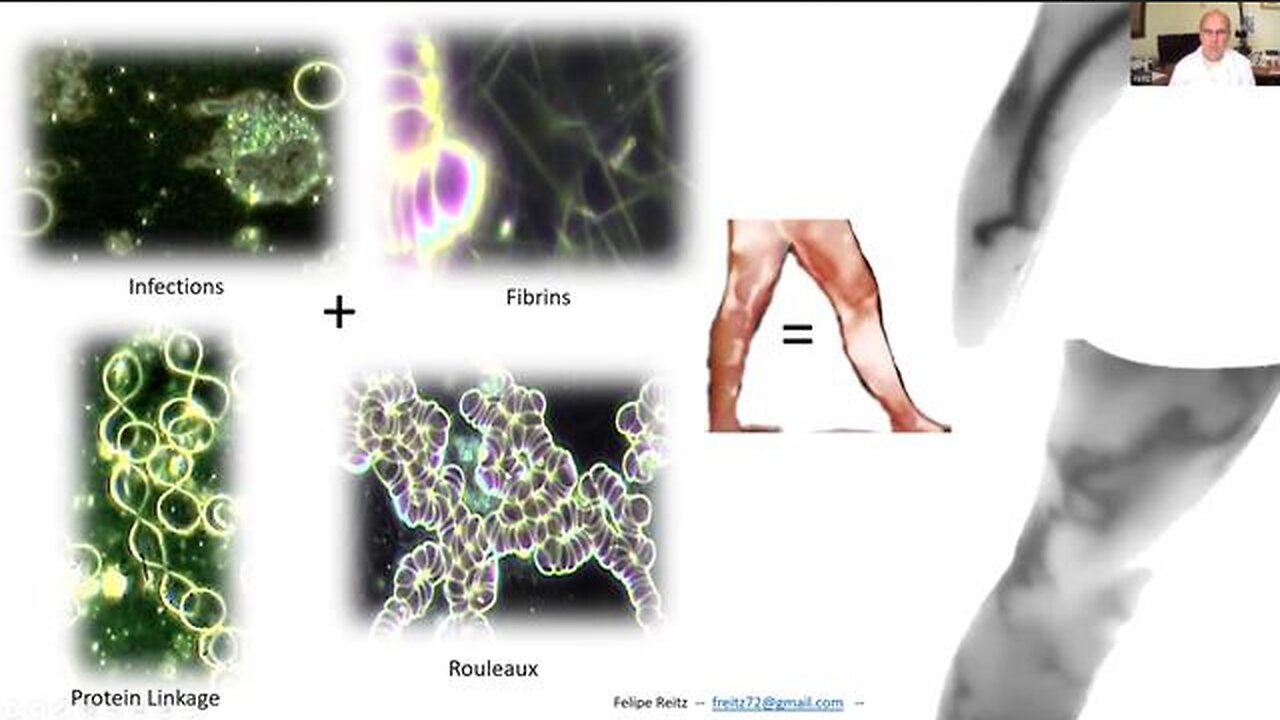 Thermographic Imaging Shows Massive Blood Clots in the Asymptomatic Vaxxed