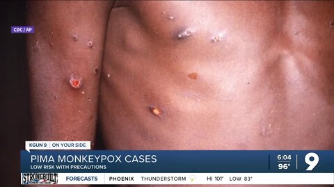 Pima Health says monkeypox a low risk