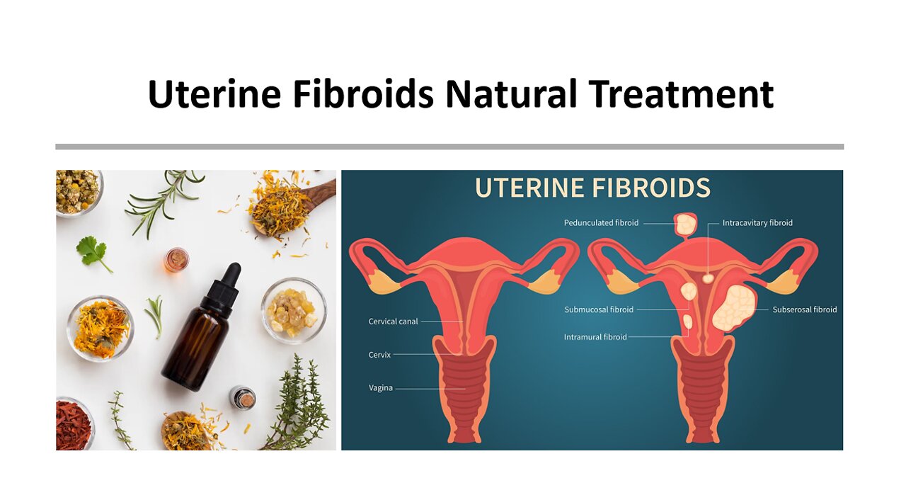 Uterine Fibroids Natural Treatment