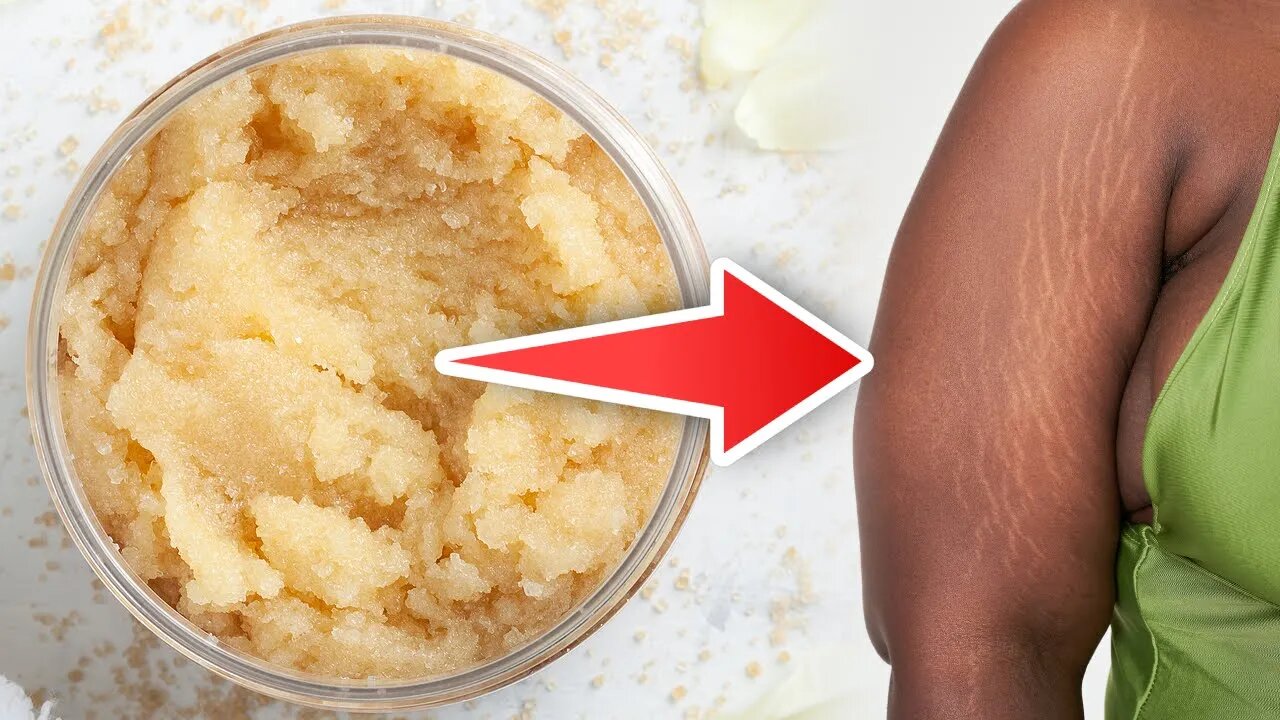 How To Get Rid of Stretch Marks Naturally